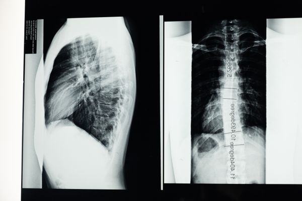 X-ray showing scoliosis spinal curvature treated with Schroth Method rehabilitation